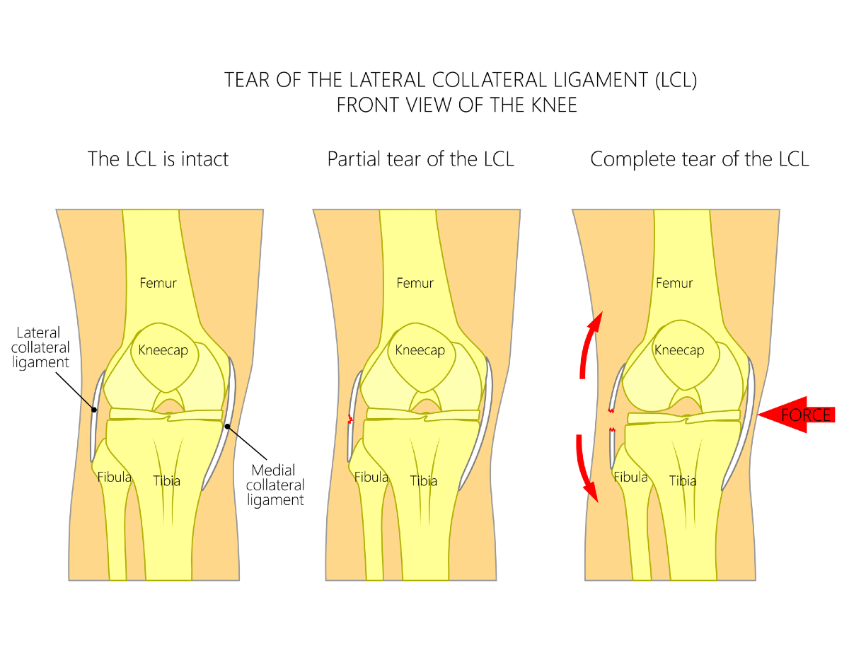 LCL-Tear